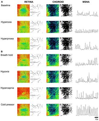 Functional-Optical Coherence Tomography: A Non-invasive Approach to Assess the Sympathetic Nervous System and Intrinsic Vascular Regulation